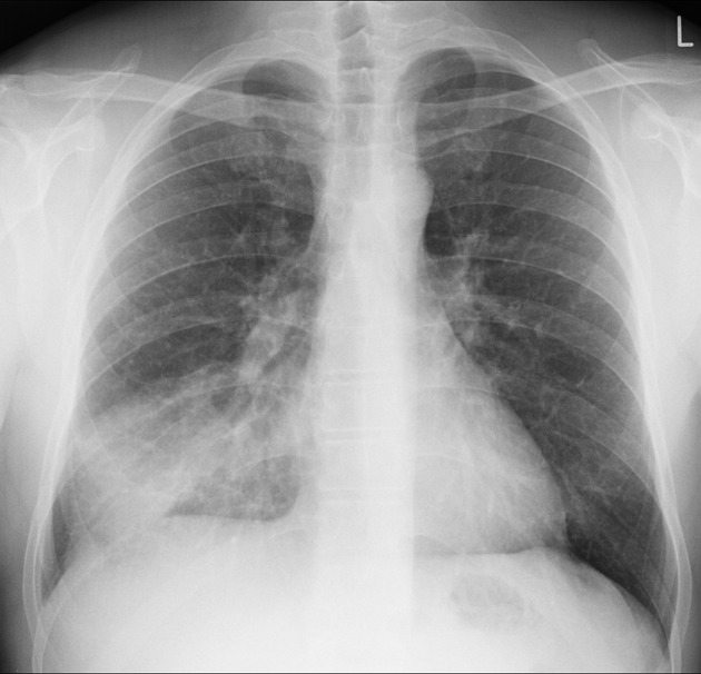 Pneumonia Detection Project